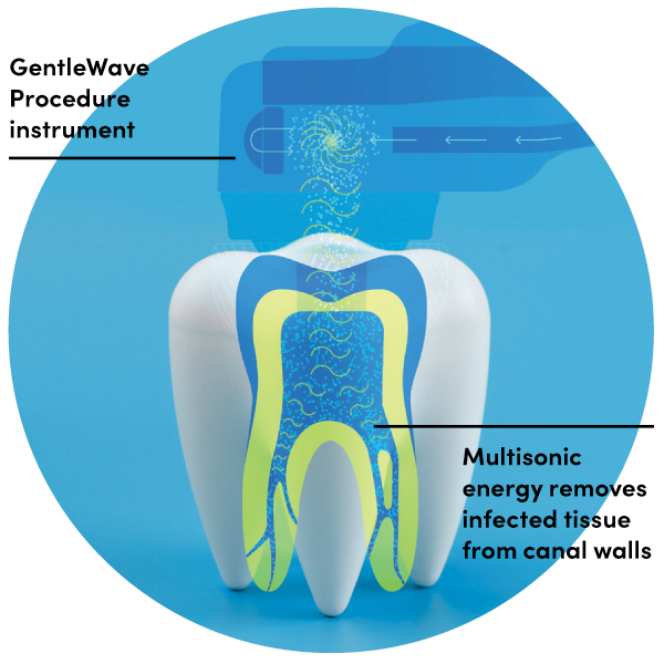 GentleWave_Procedure_graphic.png